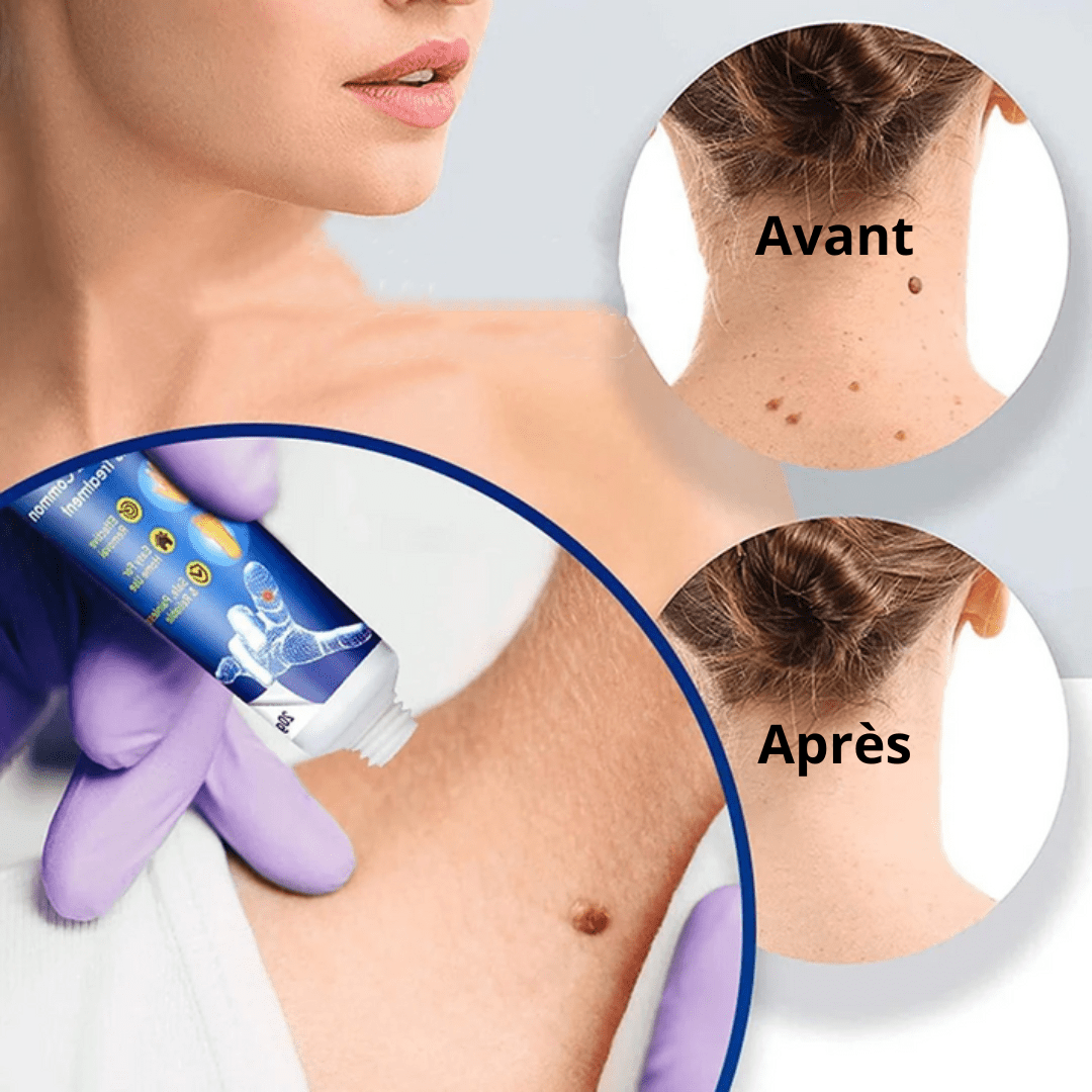 Ceoerty™ Crème anti-imperfections | Efface les verrues et les imperfections en 2 minutes!