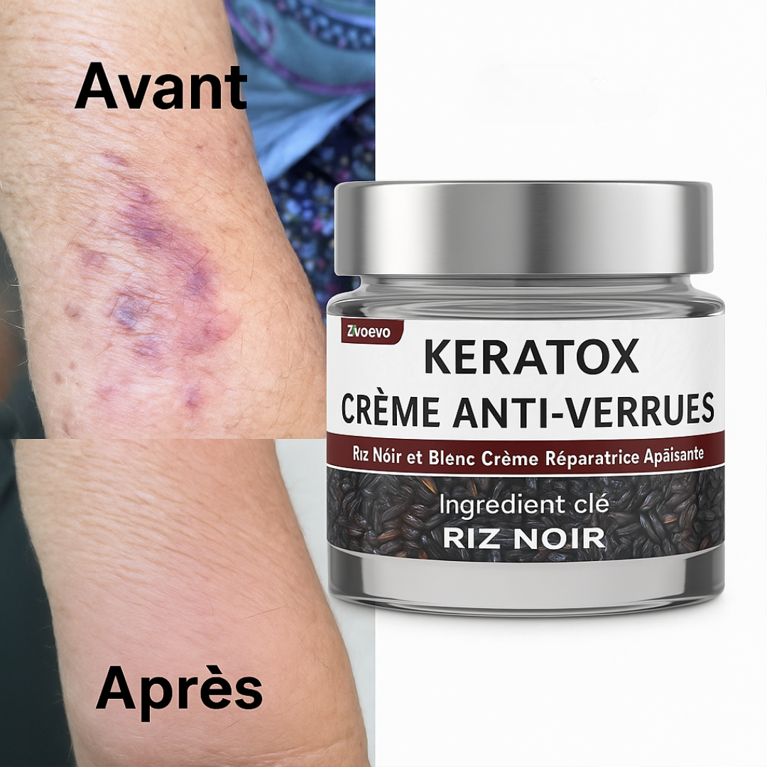 Keratox™ Crème Anti-Verrues | Élimine verrues, tumeurs cutanées et taches noires dès la 1ʳᵉ application – sans chirurgie, sans cicatrice !