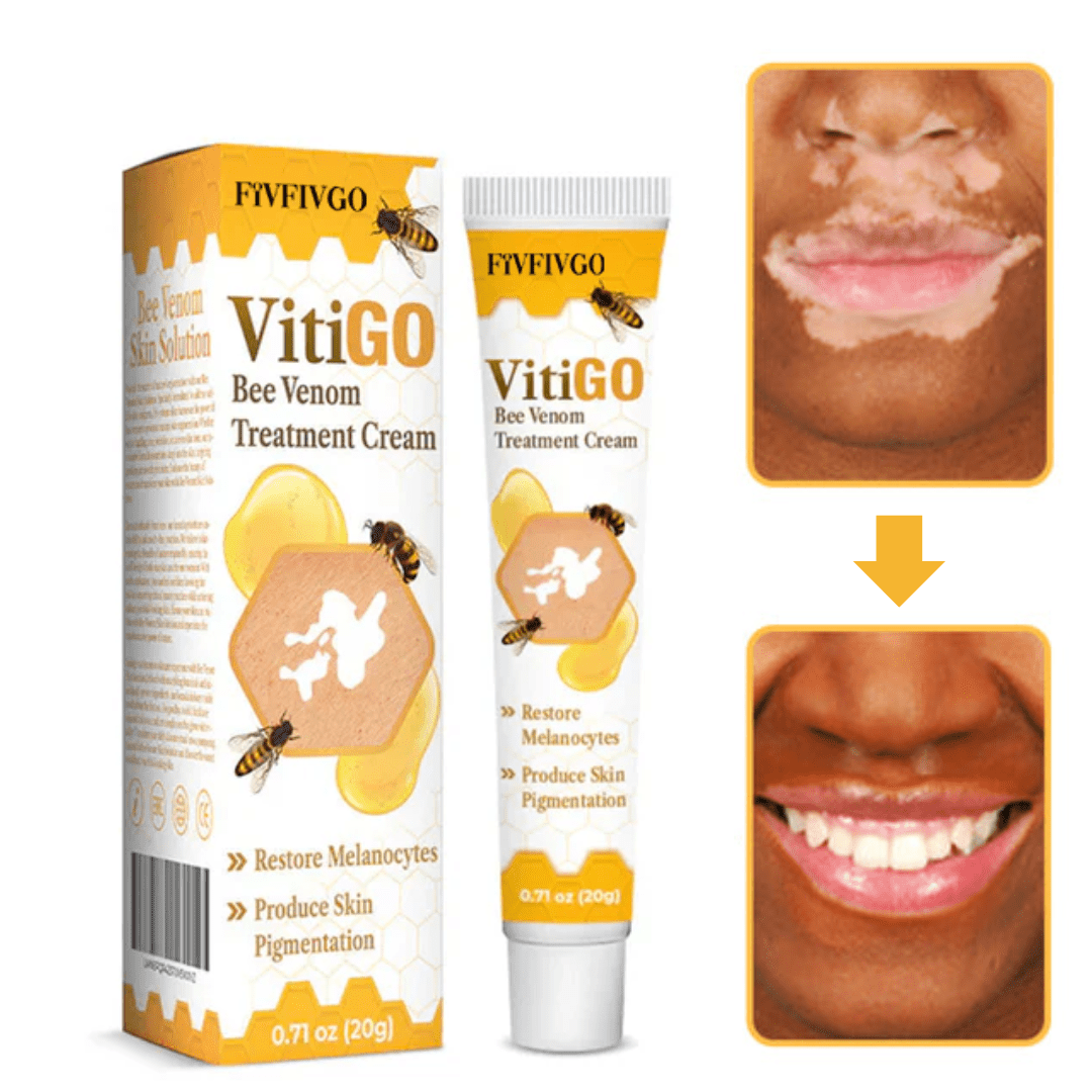 Fivfivgo™ Crème de Traitement du Vitiligo au Venin d'Abeille | Traite le vitiligo en 24 heures!