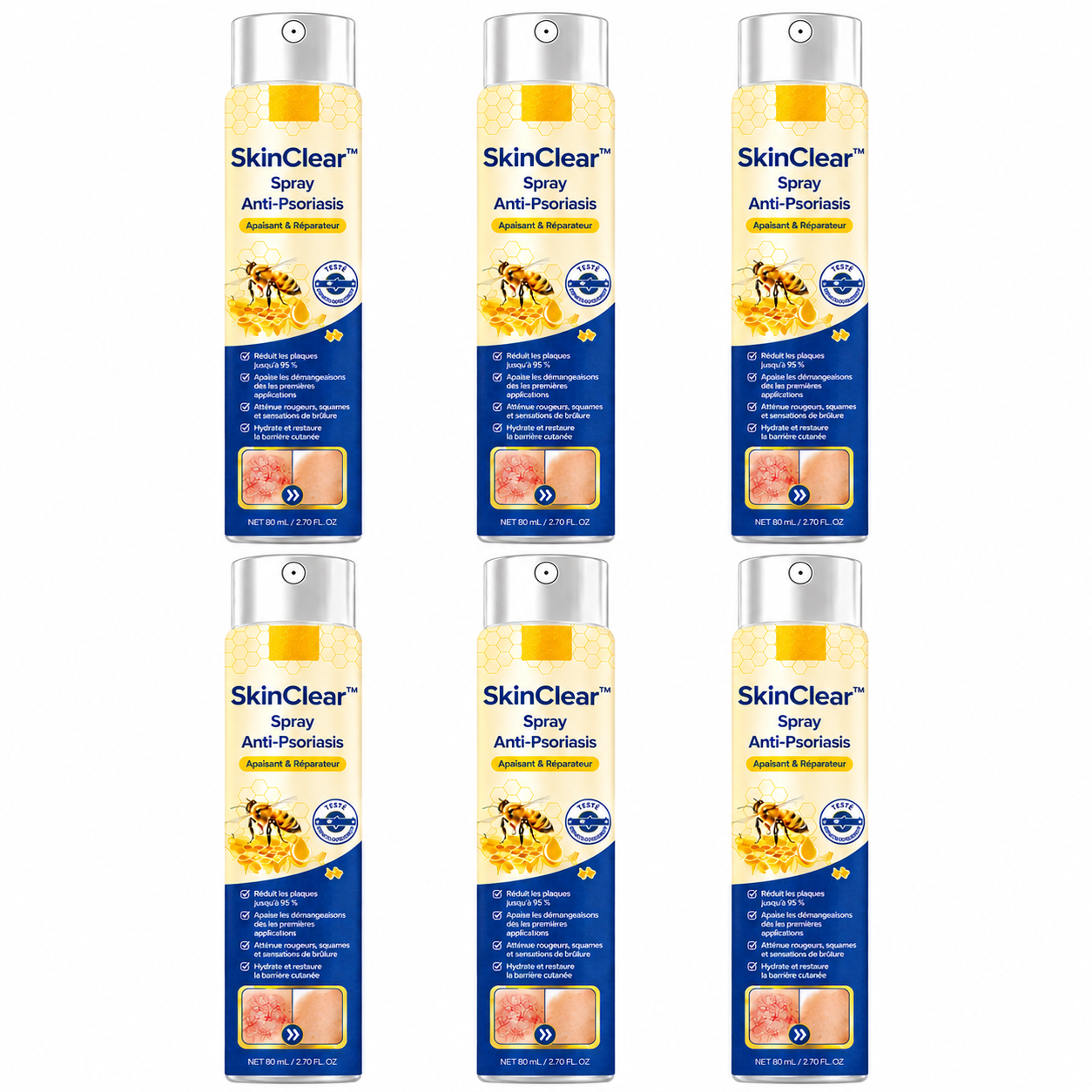 SkinClear™ Spray Anti-Psoriasis | Réduit jusqu’à 95 % des plaques et démangeaisons en quelques semaines !