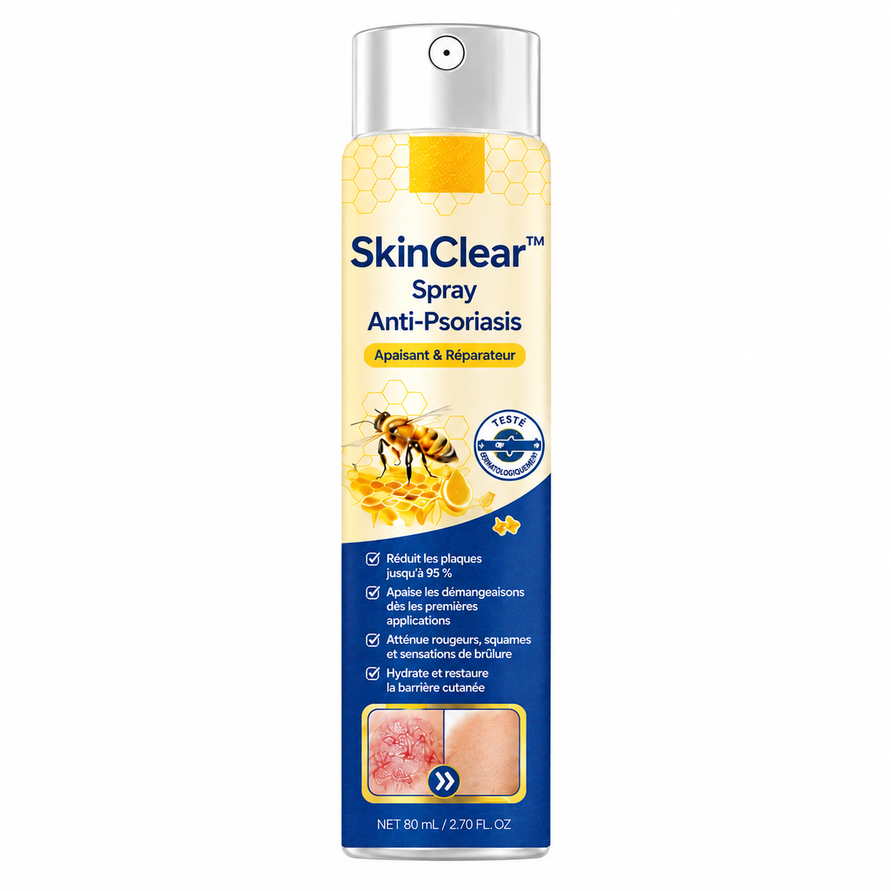SkinClear™ Spray Anti-Psoriasis | Réduit jusqu’à 95 % des plaques et démangeaisons en quelques semaines !
