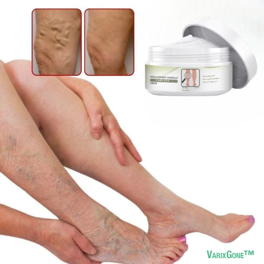 VarixGone™ Crème Anti-Varices | Efface 99 % des varices dès la 1ère application — jambes lisses instantanément !