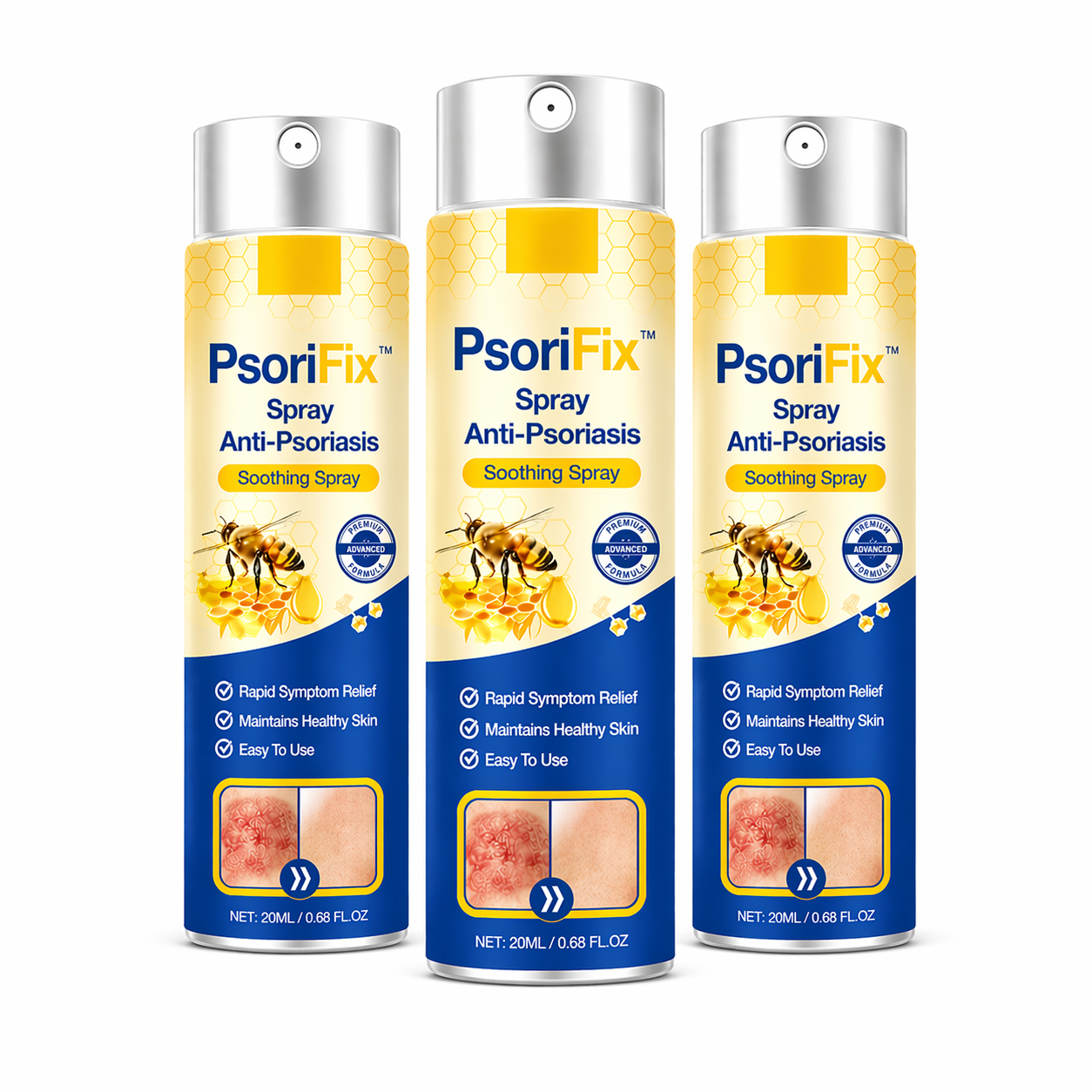 PsoriFix™ Spray Anti-Psoriasis | Réduit jusqu’à 95 % des plaques et démangeaisons en quelques semaines !