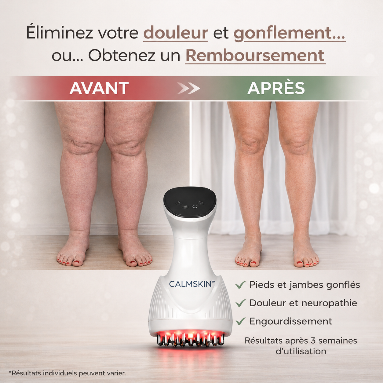 CalmSkin™ Appareil Anti-Neuropathie | Éliminez brûlures et picotements en 3 minutes !