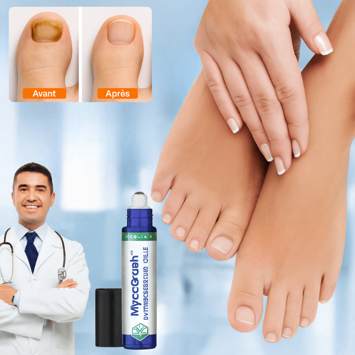 MycoCrash™ Roll-On Anti-Mycose Ultra-Ciblé | Élimine le champignon dès la 1ère application!