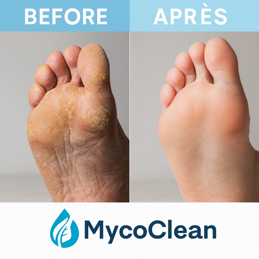 Mycoclean™ Spray Fongicide à la Cire d’abeille | Éliminez 99 % des cas de mycose des ongles en seulement 7 jours !
