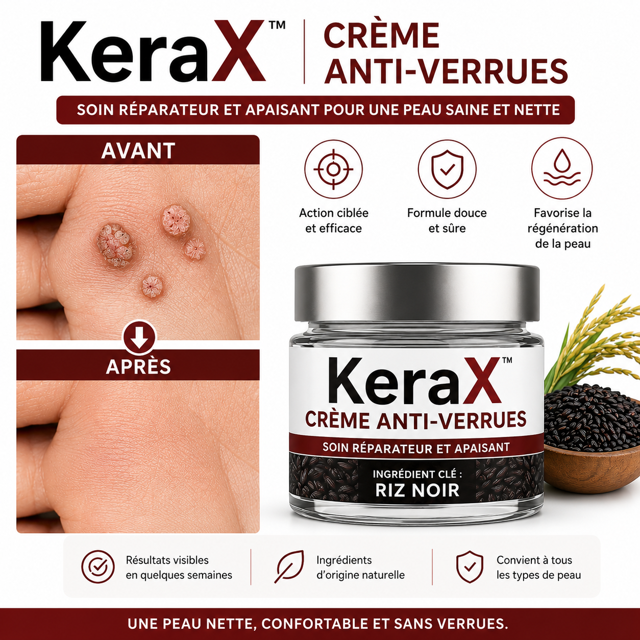 KeraX™ Crème Anti-Verrues | Élimine verrues, tumeurs cutanées et taches noires dès la 1ʳᵉ application – sans chirurgie, sans cicatrice!