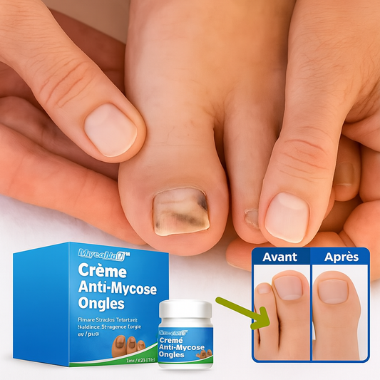 MycoNail™ Crème Anti-Mycose Ongles | Élimine 97 % des infections fongiques et régénère l’ongle en 7 jours!