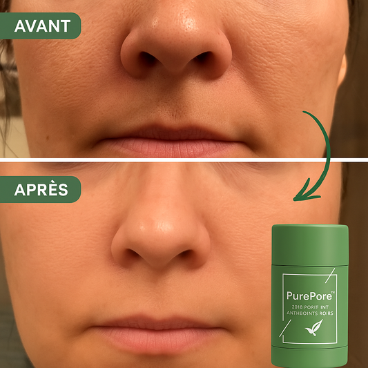 PurePore™ Soin Purifiant Anti-Points Noirs | Nettoie les pores en profondeur et illumine la peau en 5 jours!