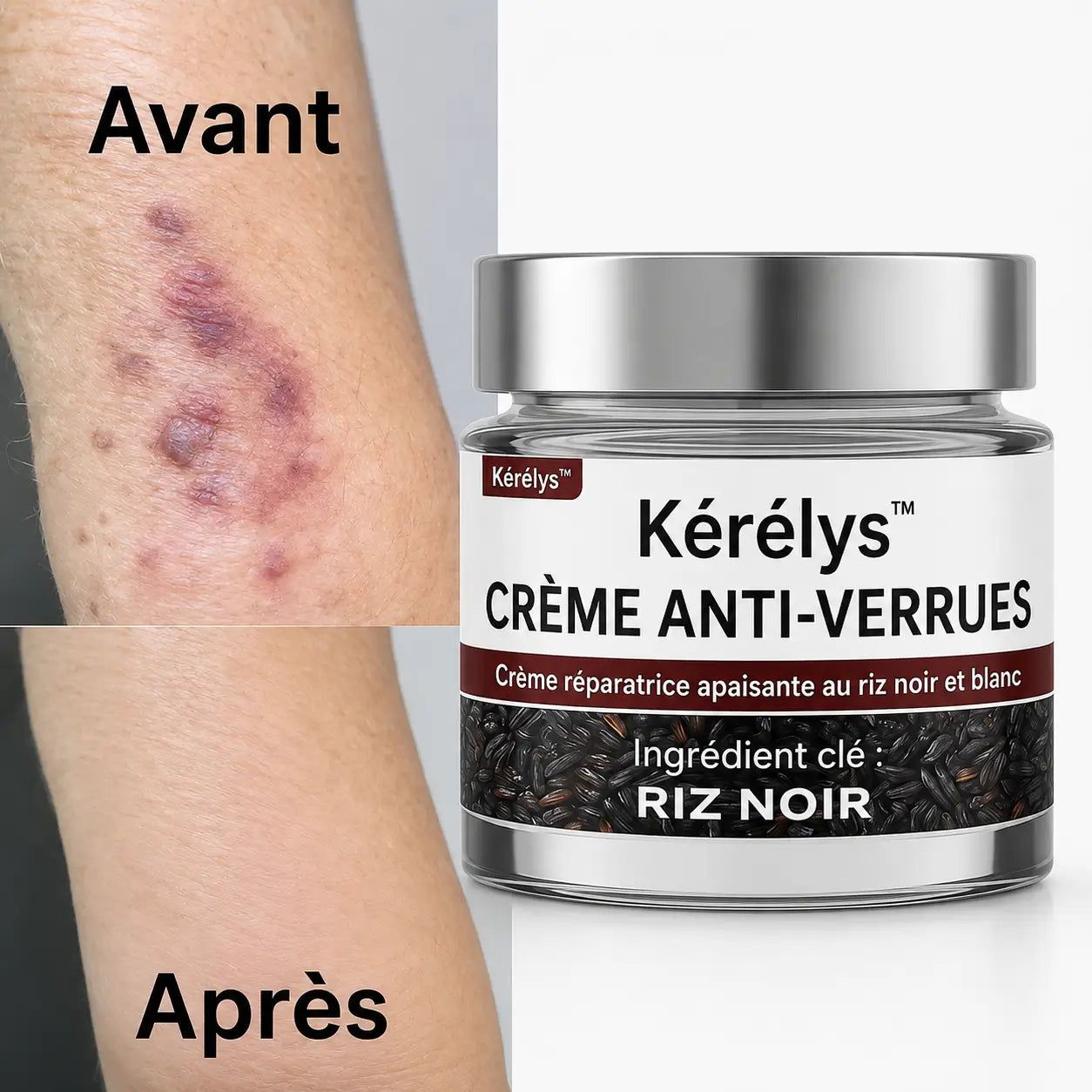 Kérélys™ Crème Anti-Verrues | Élimine verrues, tumeurs cutanées et taches noires dès la 1ʳᵉ application – sans chirurgie, sans cicatrice!