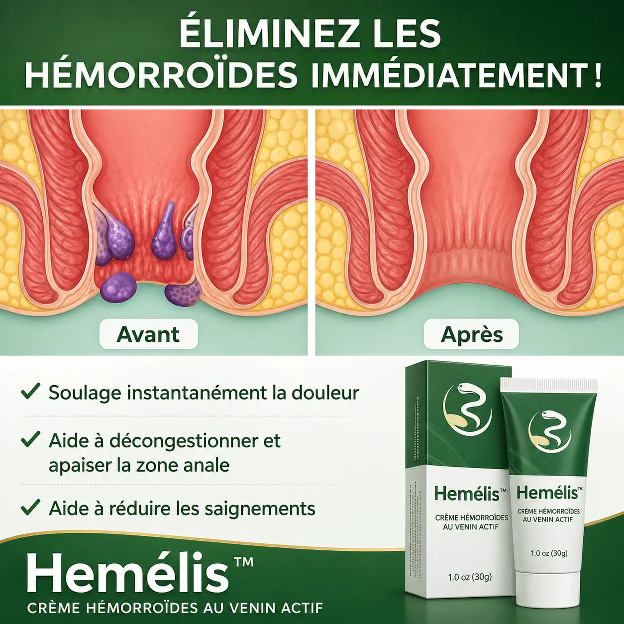 Hemélis™ Crème Hémorroïdes au Venin Actif | Éliminez la douleur et le gonflement dès la première application !