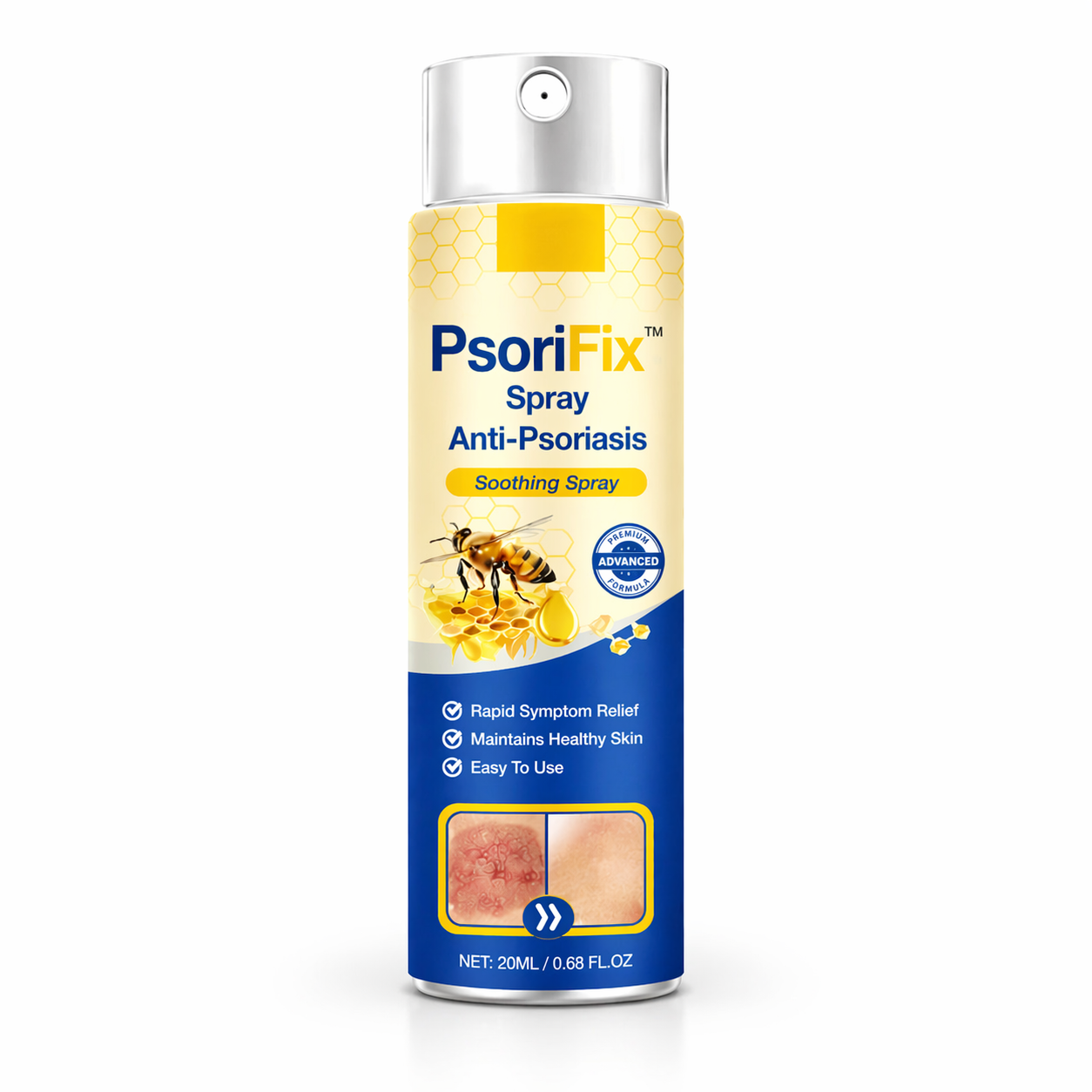 PsoriFix™ Spray Anti-Psoriasis | Réduit jusqu’à 95 % des plaques et démangeaisons en quelques semaines !
